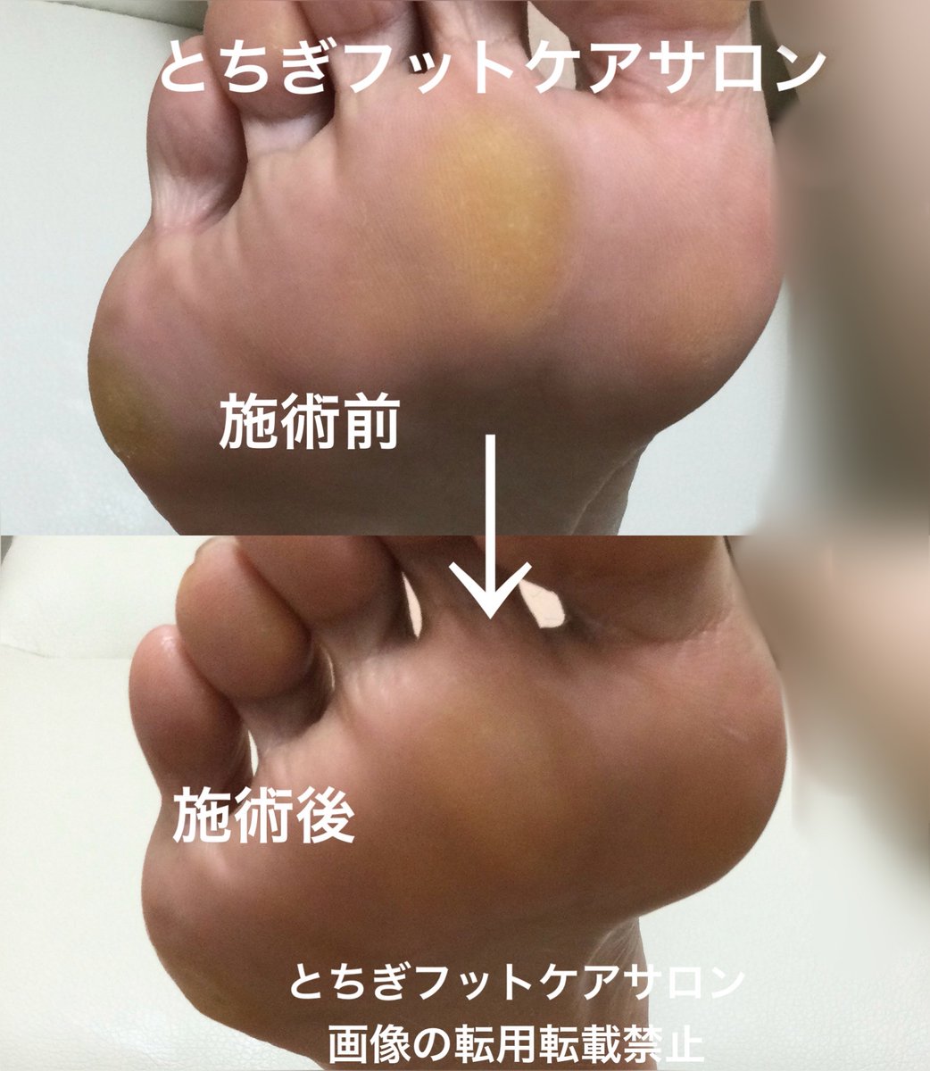 とちぎフットケアサロン-茂木有紀 (@fuss04tochigi) / Posts / X