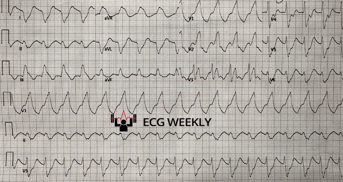 A 78-year-old woman with PMHx of atrial fibrillation presents to the emergency department. She is noted to be tachycardic on arrival, and is known to be on flecainide and takes metoprolol as needed. The following ECG is obtained on arrival....ecgweekly.com/weekly-workout…