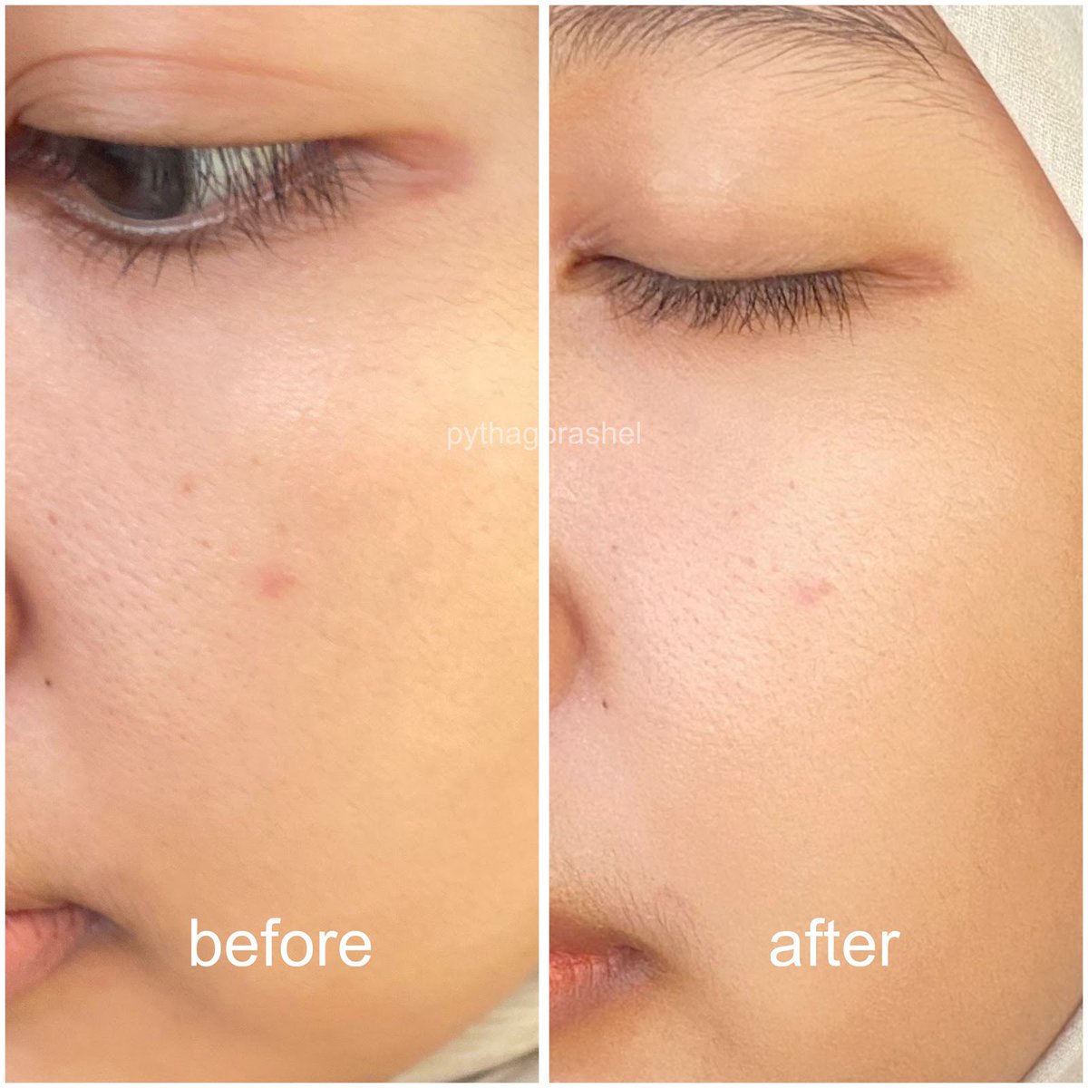 Setelah nerapin skin cycling… 
geradakan gone, mana gabikin purging samsekk

kuncinya ga pernah skip satu produk ini😆👌🏻