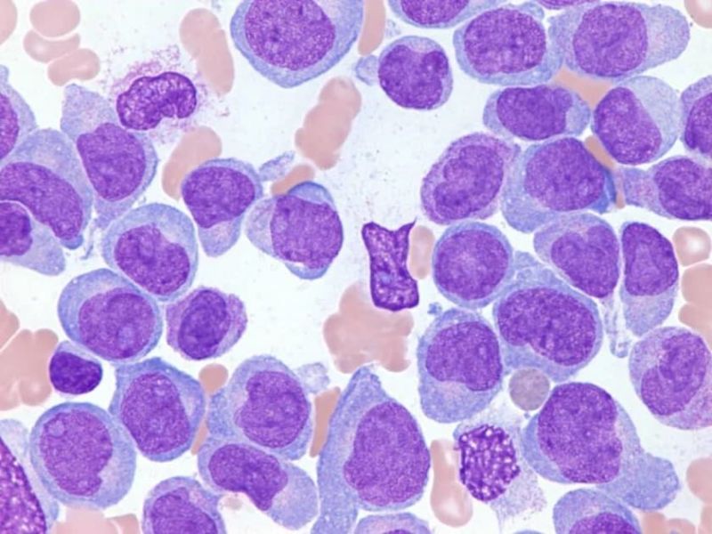 YaleMed's tweet image. Writing in @BloodPortfolio, YSM researchers at @YaleCancer have discovered a genetic #mutation linked to acute megakaryoblastic #leukemia (AMKL), a rare and aggressive #blood #cancer. Their results could pave the way for future treatments: bit.ly/46kKhnr