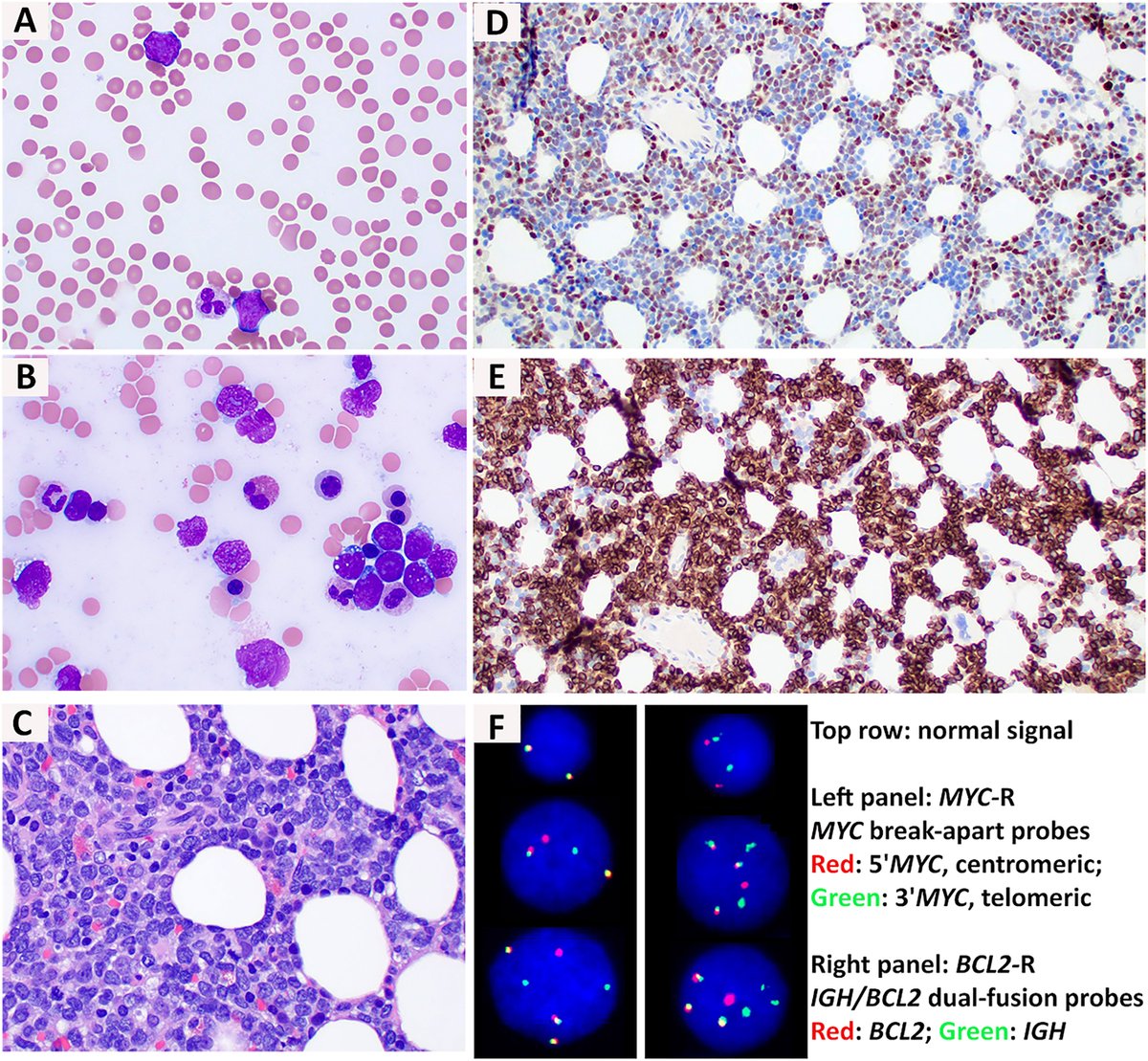 New in #HumPathol: Leukemic Phase of MYC/BCL2 Double-Hit High-grade B-cell Lymphoma: A report of 35 cases. sciencedirect.com/science/articl… #pathology #PathTwitter #PathX #hemepath