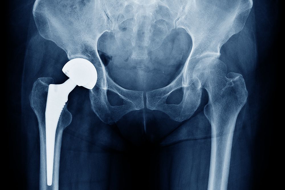 Hip replacement is life-changing, but it’s still major surgery. 🦴

Dr. Cafferky minimizes risks like blood clots, infection &amp; nerve damage with advanced tools, tailored care &amp; strong recovery support.

👉 Learn more: buff.ly/qeI5o7S 

#HipReplacement #DrCafferky