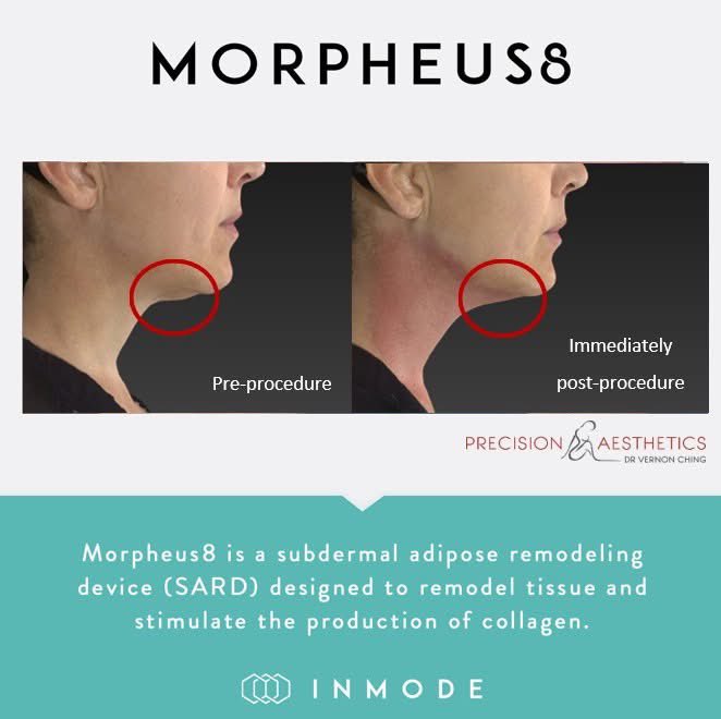 ✨ Patient Transformation with Morpheus8 ✨

Patient concerned about sagging skin under the chin. Immediate visible improvement post-procedure

#morpheus8 #INMODE #turkeyneck #RejuvenateYourSkin #microneedling #drvching #PrecisionAesthetics