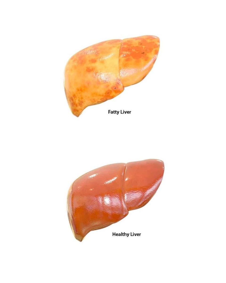 Fatty liver was completely reversed using one simple, cheap supplement, in a fascinating study.

(🧵1/8)
