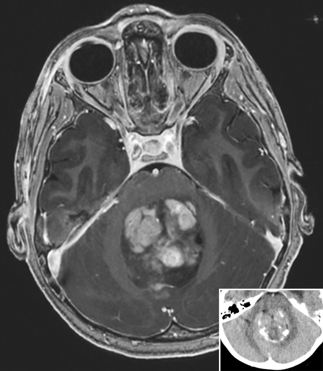 brainpathol's tweet image. UNDER YOUR MICROSCOPE: A posterior fossa mass in a 4-year-old female

Whole slide image: isn-slidearchive.org/?col=ISN&amp;amp;fol=A…

What's your diagnosis?
#neuropath @Kenneth_Aldape 

Full case discussion here: onlinelibrary.wiley.com/doi/10.1111/bp…