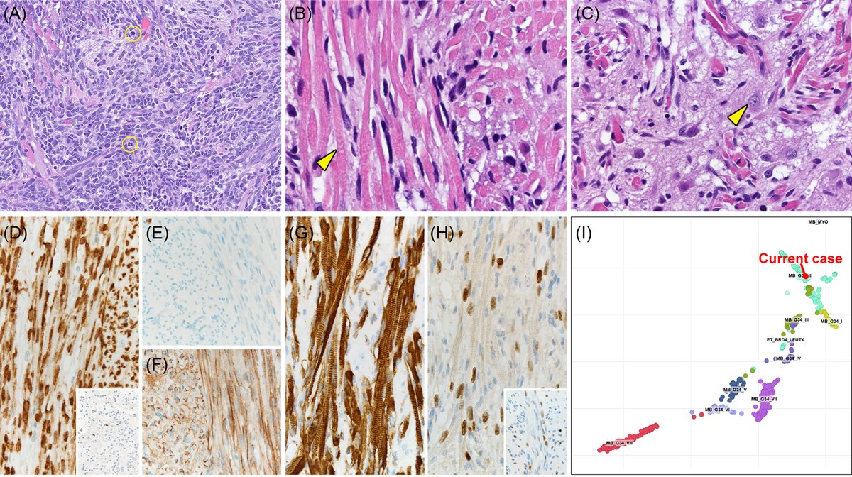 brainpathol's tweet image. UNDER YOUR MICROSCOPE: A posterior fossa mass in a 4-year-old female

Whole slide image: isn-slidearchive.org/?col=ISN&amp;amp;fol=A…

What's your diagnosis?
#neuropath @Kenneth_Aldape 

Full case discussion here: onlinelibrary.wiley.com/doi/10.1111/bp…