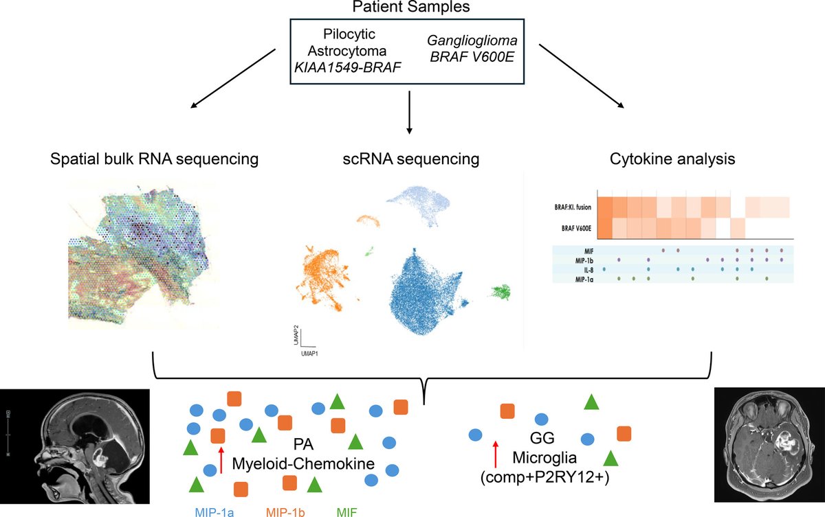 brainpathol's tweet image. Multi-pronged analysis of pediatric low-grade glioma and ganglioglioma reveals a unique tumor microenvironment associated with BRAF alterations
onlinelibrary.wiley.com/doi/10.1111/bp…