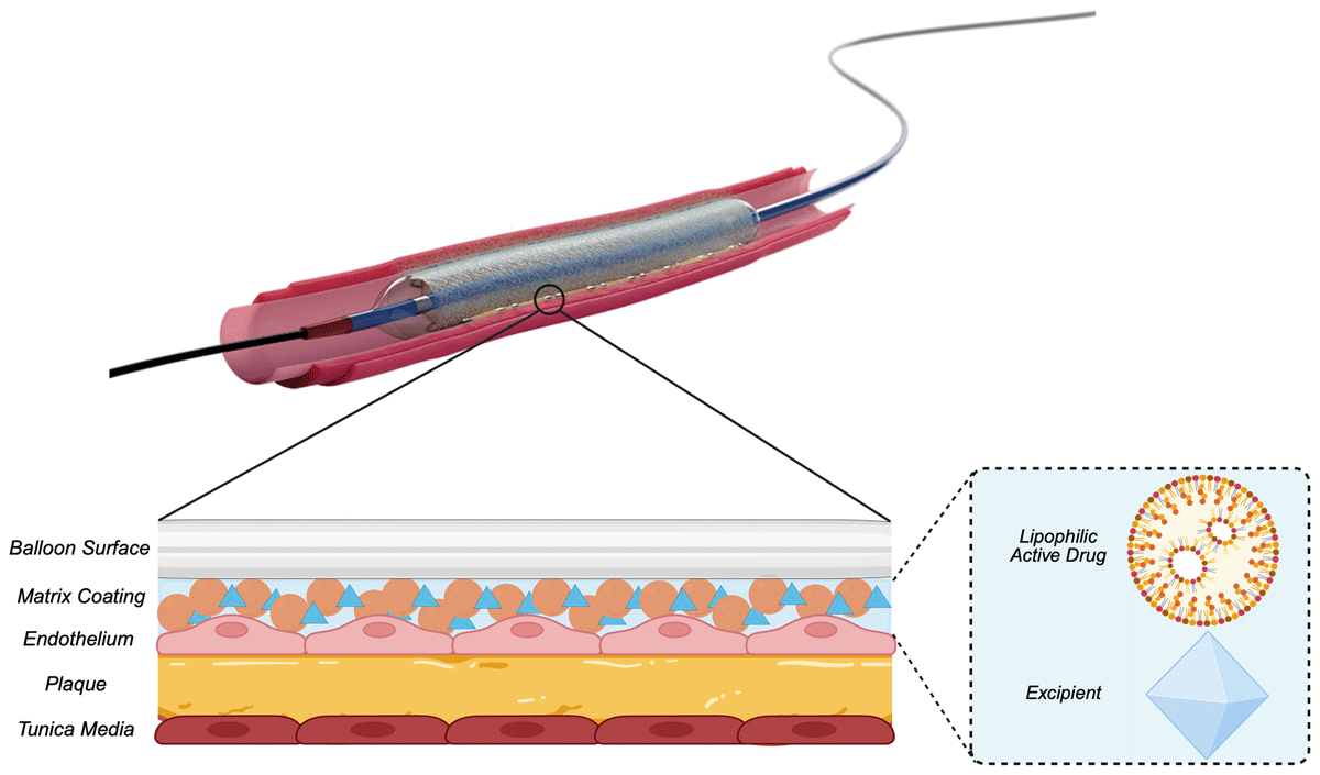 DeBakeyCVedu's tweet photo. Viable alternative to coronary stents, #DCB “leave nothing behind” approach reduces need for permanent stents &amp; minimizes risks

Drug-Coated Balloons for Coronary Interventions - @ahpatelmd @MarkAbdelnour1 @DrAFrangieh  @UCI_Cardiology

#DeBakeyCVJournal https://t.co/CNk6ZMfvQI https://t.co/U4l5Q0Gj5p