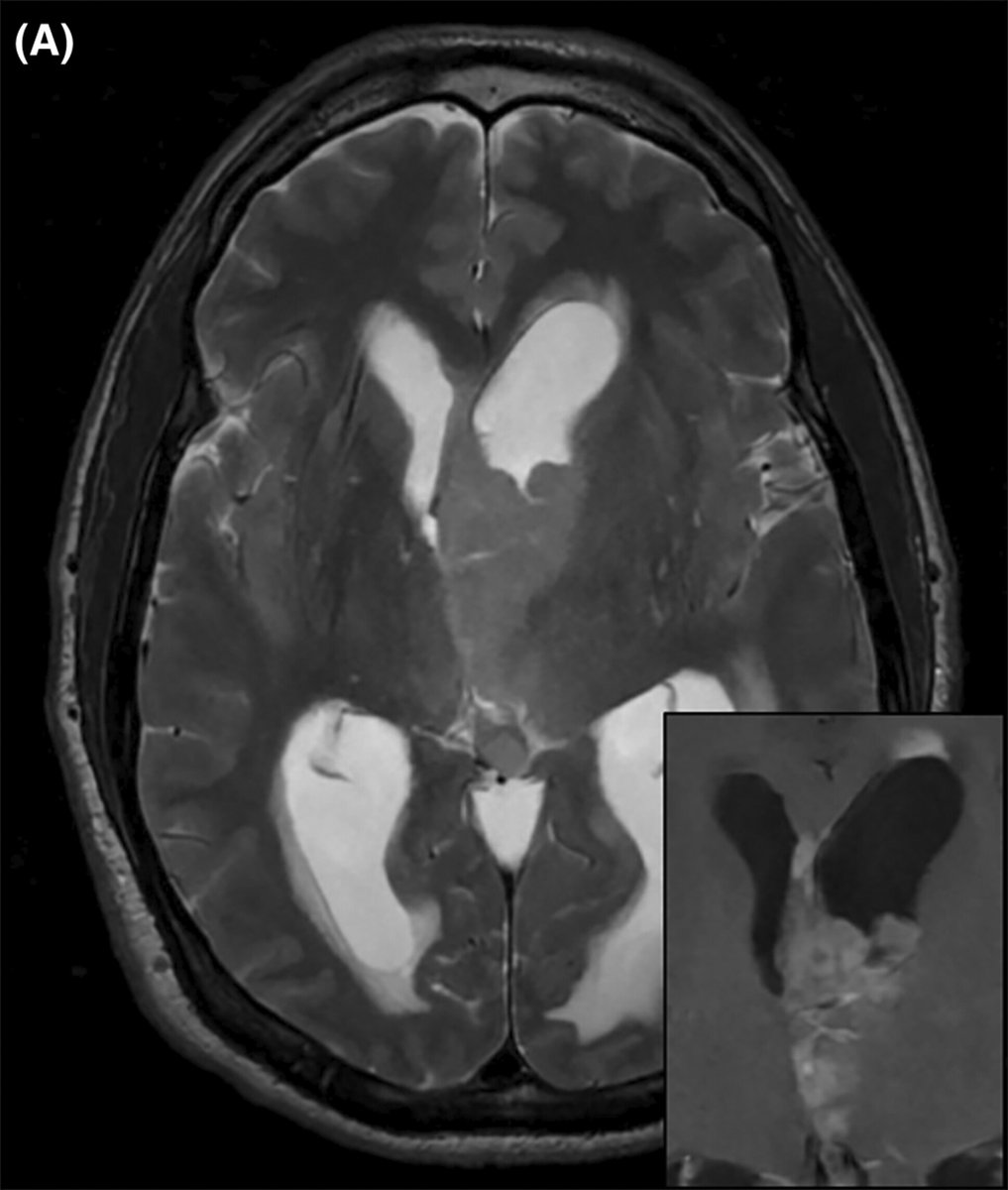 brainpathol's tweet image. UNDER YOUR MICROSCOPE: Intraventricular mass in a 49-year-old male

Whole slide image: isn-slidearchive.org/?col=ISN&amp;amp;fol=A…

What&apos;s your diagnosis?
#neuropath

Full case discussion here: onlinelibrary.wiley.com/doi/10.1111/bp…