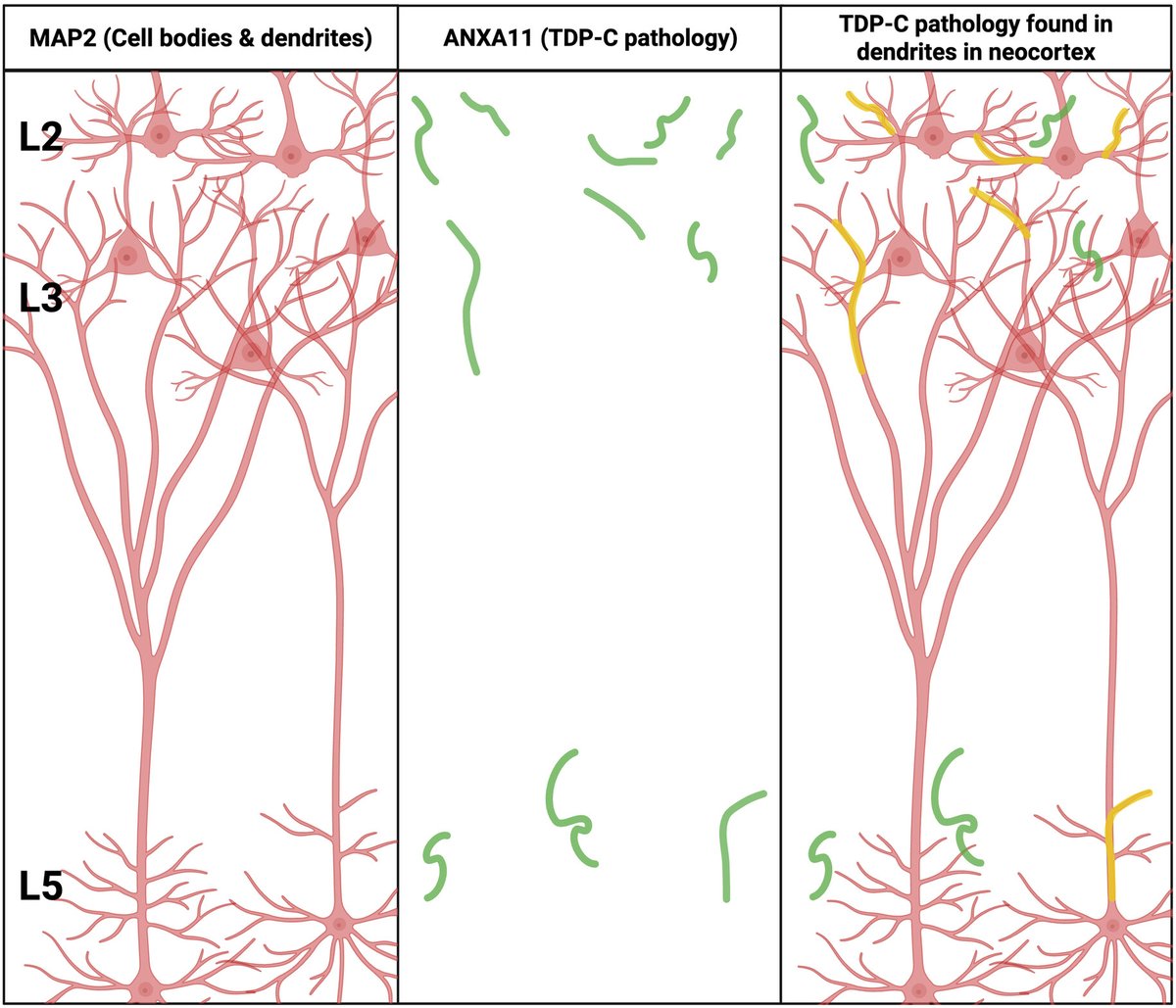 Dendritic location of dystrophic neurites in FTLD-TDP type C with annexinopathy
onlinelibrary.wiley.com/doi/10.1111/bp…