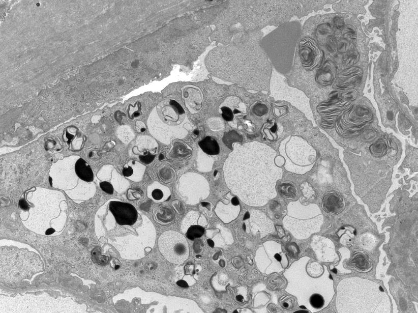 JZRenalPath's tweet image. Lupus nephritis case with prominent podocyte cytoplasmic vacuolization on LM with myelin figures revealed by EM. Probably HCQ effect but given its prominence genetic etiologies should be excluded (e.g., Fabry, LMX1B). #renalpath #pathtwitter #nephrology