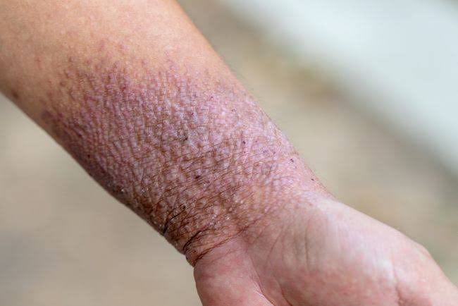 valiisaa's tweet photo. Pernah nggak gatal banget, terus pakai lotion atau salep, lalu muncul sensasi dingin yang bikin adem? 
 Itu biasanya berkat MENTOL
Tapi, kok bisa ya gatalnya jadi lebih reda hanya karena rasa dingin?

Utas