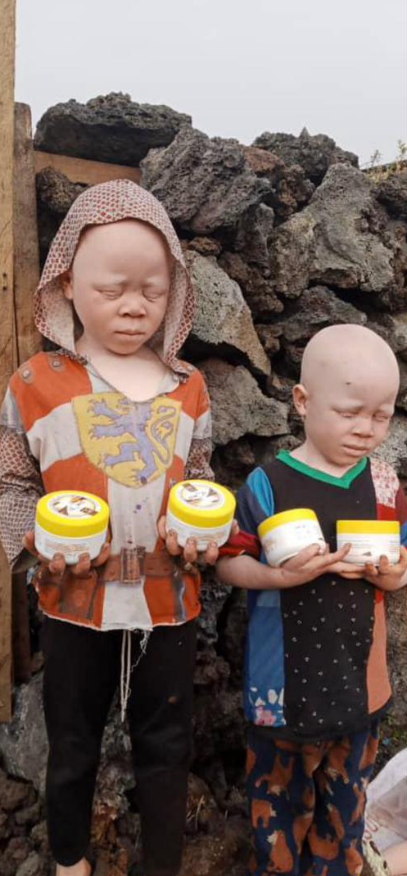 HealthAlert_Org's tweet photo. Every new week is a chance to rise , to speak louder, and to prove that disability is not inability.

#Health 
#albino https://t.co/5NNuPltUvI