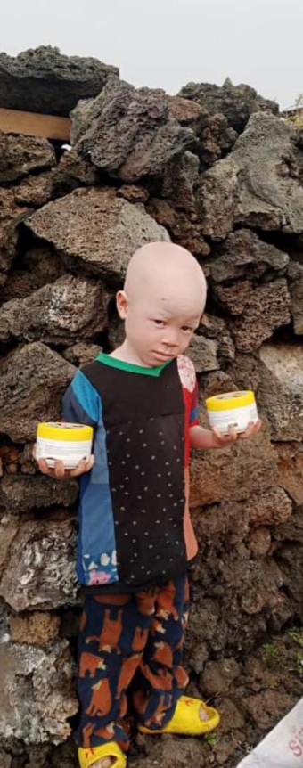 HealthAlert_Org's tweet photo. Every new week is a chance to rise , to speak louder, and to prove that disability is not inability.

#Health 
#albino https://t.co/5NNuPltUvI