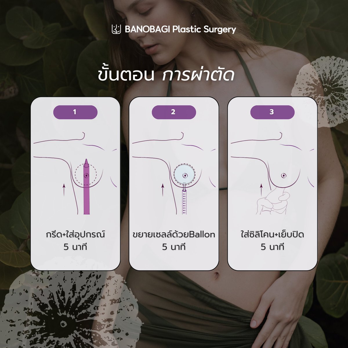 banobagithai's tweet image. เสริมหน้าอกเทคนิคใหม่ล่าสุด Motiva Preserve 🍃

มีเพียง 5 แห่งในเกาหลีเท่านั้น! ซึ่งทางโรงพยาบาลศัลยกรรมบาโนบากิของเราได้รับการแต่งตั้งอย่างเป็นทางการของ Motiva Preserve ✨

#banobagi #บาโนบากิ #เสริมหน้าอก #motiva  #ศัลยกรรมเกาหลี #โปรโมชั่น #ยกกระชับ