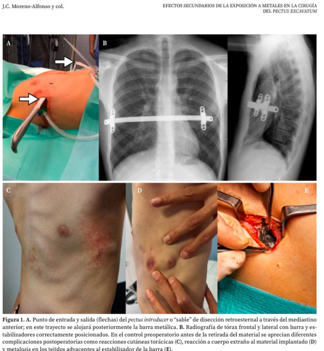 CirPediatrForal's tweet image. Reciente publicación de nuestro Servicio en torno a la presencia de #metales en orina en portadores de implantes metálicos tras la corrección del #pectus #excavatum 

Link: pubmed.ncbi.nlm.nih.gov/40838288/

@Me4Ped @SECIPE @salud_na @sopequin