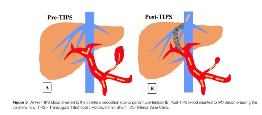 Manejo del Sangrado Variceal Refractario en Pacientes con Cirrosis 🩸

🔰📚JOURNAL OF CLINICAL AND EXPERIMENTAL HEPATOLOGY

doi.org/10.1016/j.jceh…

Enlace a Artículo Completo 👇🏼✅🆓t.me/SoMELaguna