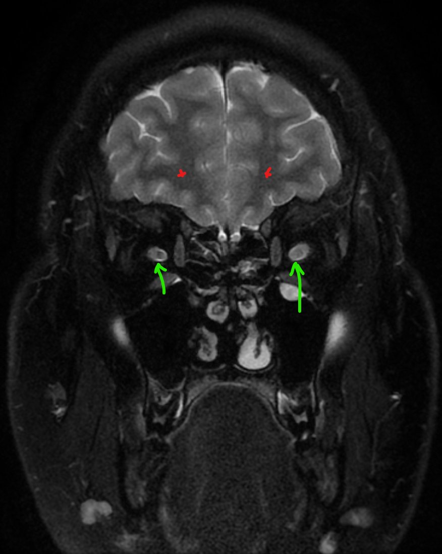 whitfieldlewis6's tweet photo. 👁️‍🗨️ Sometimes MRI findings are subtle.
Radiologists don’t get the luxury of a bedside exam — instead, they develop hawk eyes (and, depending who you ask, very expensive high-resolution monitors 😅).
Yesterday, I showed you what’s normal:

Optic nerve = white matter tract

On T2: gray matter = light, white matter = dark

So the optic nerve should match cerebral white matter → dark signal.

Now look at this coronal MRI T2 of the orbits with fat suppression (fat sat):

T2: gray matter lighter, white matter dark, CSF bright

Orbital fat = normally bright on T2 → here it’s suppressed (fat sat), so it appears dark and pathology stands out

Red asterisks = cerebral white matter (dark, normal)

Green arrows = optic nerves → only one matches white matter intensity (normal)

🧑‍⚕️ Clinical vignette:
20-year-old with family history of MS, 2-day history of monocular blurry vision.

❓Which eye is affected?
📌 Courtesy: Radiopaedia – Optic neuritis (MS)

#Neuroradiology #MultipleSclerosis #MRI #Neurology #Neuroophthalmology

See yesterday's explanation of MRI coronal optic nerve anatomy in the comment section of this tweet... below 👇👇