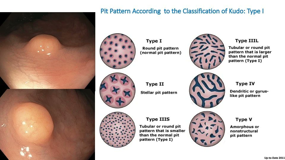 All the key steps to visually diagnose a rectal carcinoid (NET)

Never miss this lesion again! 👁️

The best course to train your eyes to detect and characterize colon polyps is on EndoCollab