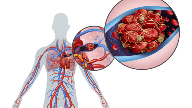 📚 Latest News : "HI-PRO: Low-Dose Apixaban Reduces Recurrent VTE in Provoked Cases with Enduring Risk"

 🔓Access it here 👉 ow.ly/L0hx106l9oI
