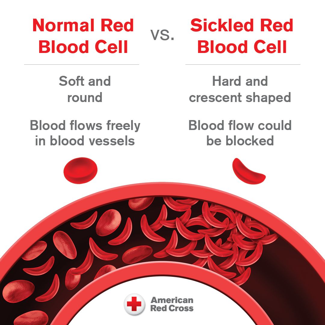 #SickleCellAwarenessMonth: Sickle cell disease disproportionately impacts the Black community &amp; blood donors who are Black may uniquely be able to help. Blood transfusions can help manage extreme pain &amp; disease complications. Give blood with the Red Cross: rcblood.org/3dEEnoj