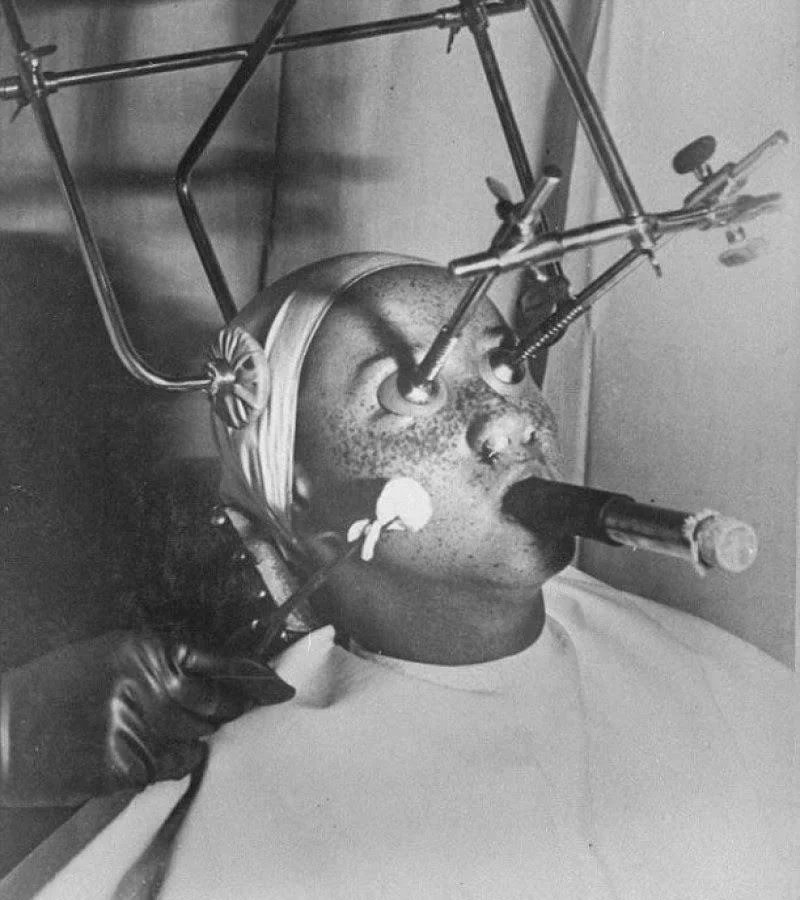 صورة من ثلاثينيات القرن الماضي لطريقة إزالة النمش باستخدام ثاني اكسيد الكربون شكلها كأنها مشهد رعب بس كانت تعتبر عملية تجميلية وقتها