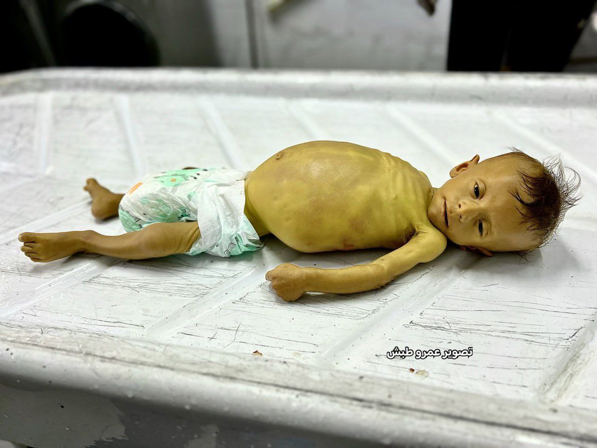 🔷Un enfant palestinien de six mois est mort de malnutrition.
Fahmad Al-Masri L'enfant palestinien est mort de malnutrition sévère, d'une hypertrophie du foie et d'un manque de médicaments causés par l'agression de l'armée israélienne.