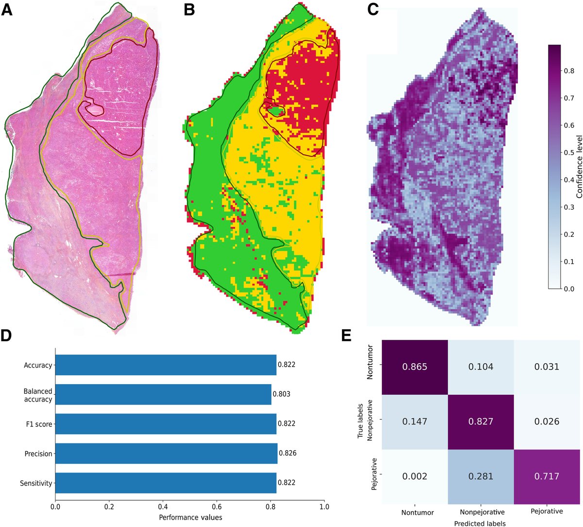 AJPathology's tweet image. #LegacyContent: #DeepLearning Classification and Quantification of Pejorative and Nonpejorative Architectures in Resected Hepatocellular Carcinoma from Digital Histopathologic Images
Free in the #OpenArchive: ajp.amjpathol.org/article/S0002-…