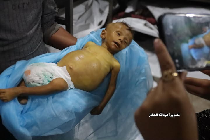 Timesofgaza's tweet photo. Infant Fahd Al-Masri (6 months) died at Nasser Hospital in Khan Younis due to severe malnutrition and lack of medical and treatment resources caused by the Israeli blockade. https://t.co/2lTgB6zw8m