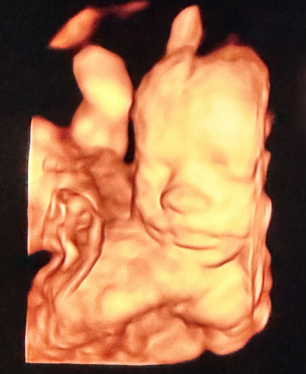 My wife is 31 weeks pregnant today; this is an ultrasound of my son at 26 weeks.

In nine states—Alaska, Colorado, Minnesota, New Hampshire, New Jersey, New Mexico, New York, Oregon, Vermont—and Washington, D.C., aborting my child is still legal. A 31-week baby is significantly