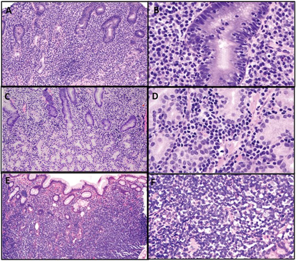 Human_Pathology's tweet image. New in #HumPathol: Interdisciplinary Analysis of Cues to Triage Gastric Lymphoid Proliferations: Role of the Surgical Pathologist Revisited. sciencedirect.com/science/articl… #pathology #PathTwitter #PathX #GIpath