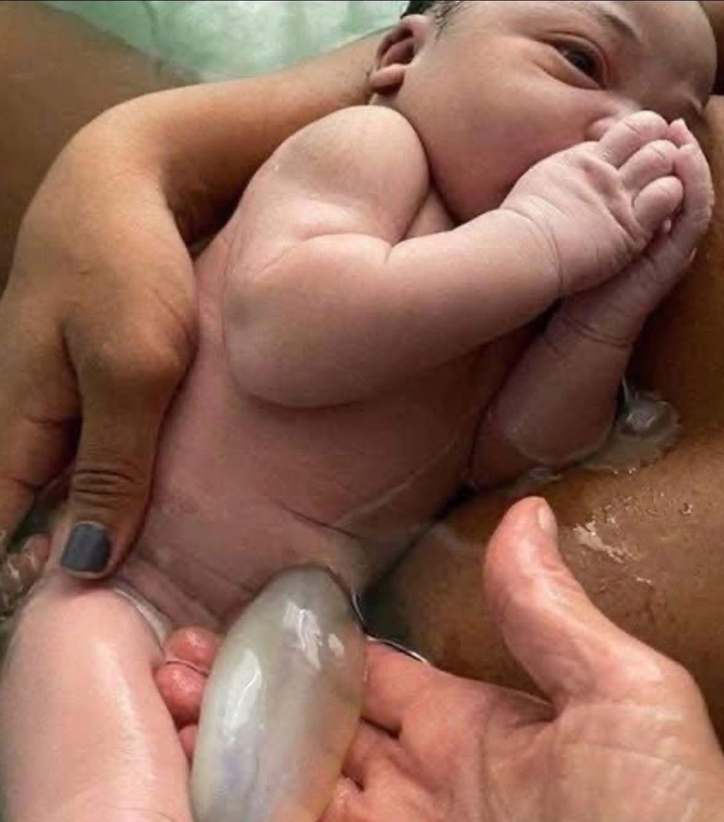 "This is what an umbilical cord is supposed to look like.
White. 
Limp. 
Translucent.
Because its mission is complete.
Every last drop of cord blood has been delivered to the baby as designed.
But that’s not what usually happens.
In most hospitals, the cord is clamped and cut