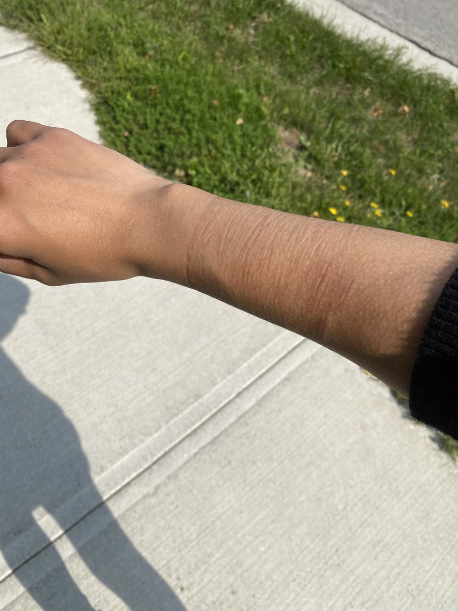 First time my scars have felt the sun and wind

It felt nice(о´∀`о)