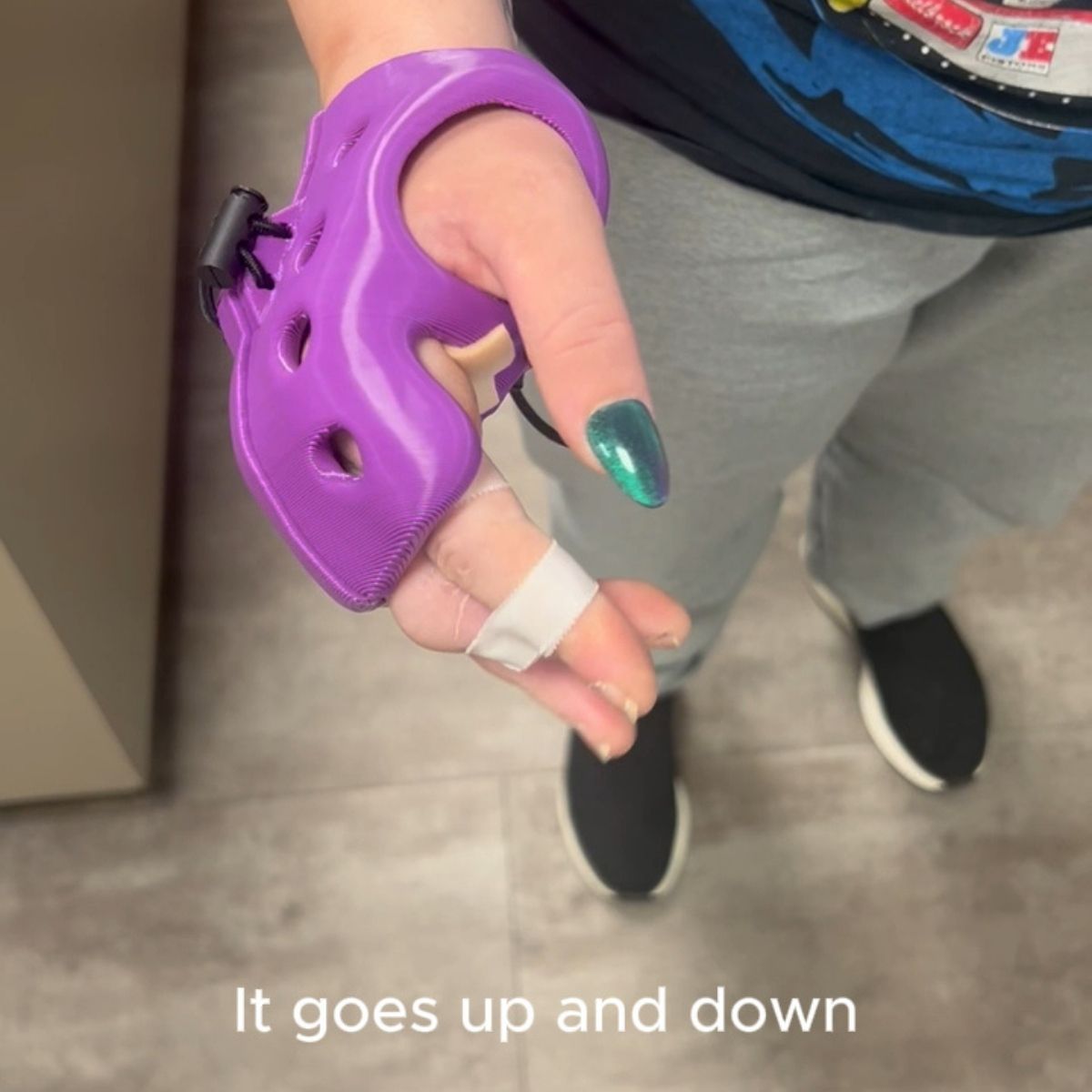 ActivArmor's tweet image. Dorsal MP blocker, short-hand gauntlet style for a bad industrial drill injury that nearly took her middle finger off &amp;amp; dislocated the MCP joints = back to work earlier for workers&apos; compensation case.  #ActivArmor #WaterproofCast #WorkersComp  #WorkplaceInjury