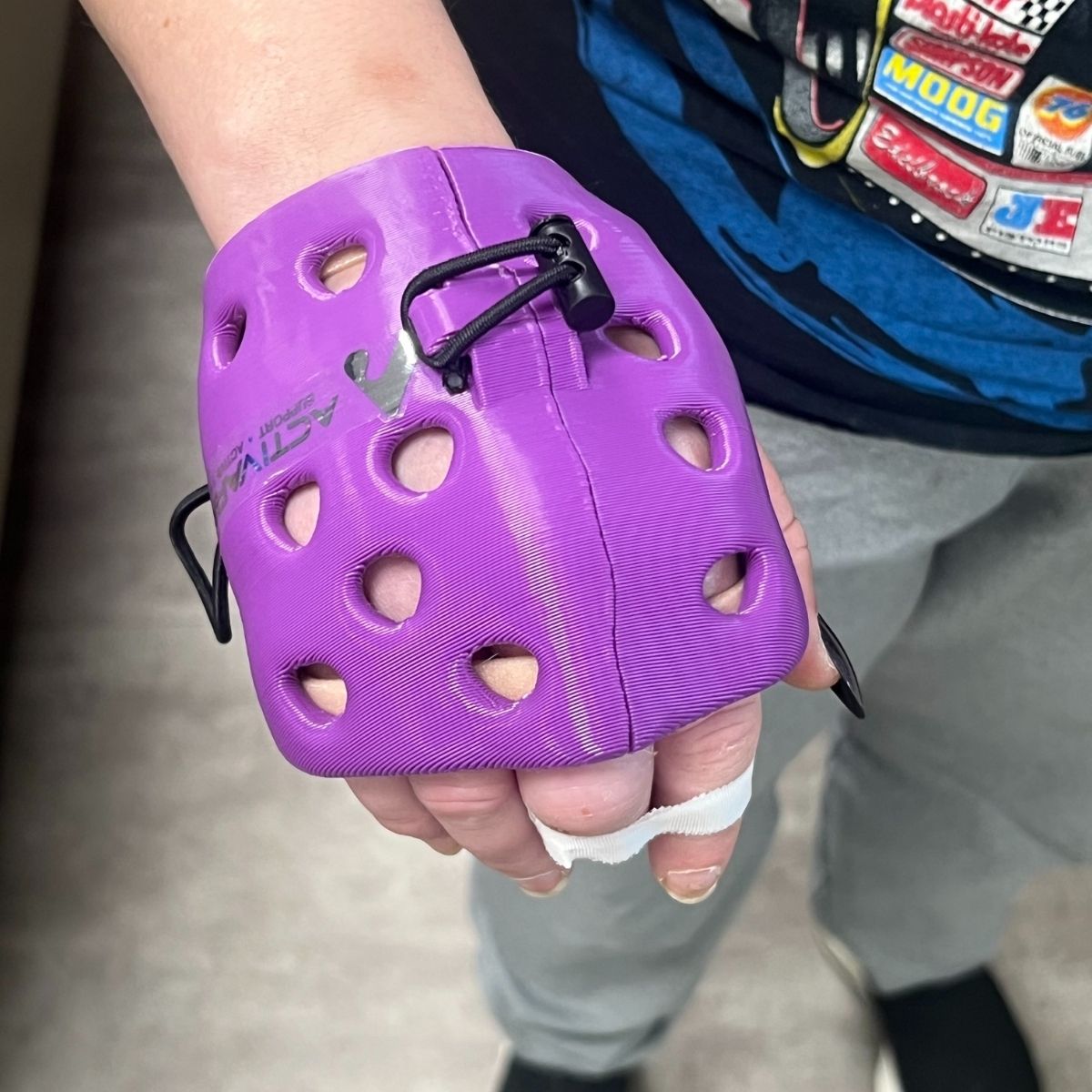 ActivArmor's tweet image. Dorsal MP blocker, short-hand gauntlet style for a bad industrial drill injury that nearly took her middle finger off &amp;amp; dislocated the MCP joints = back to work earlier for workers&apos; compensation case.  #ActivArmor #WaterproofCast #WorkersComp  #WorkplaceInjury