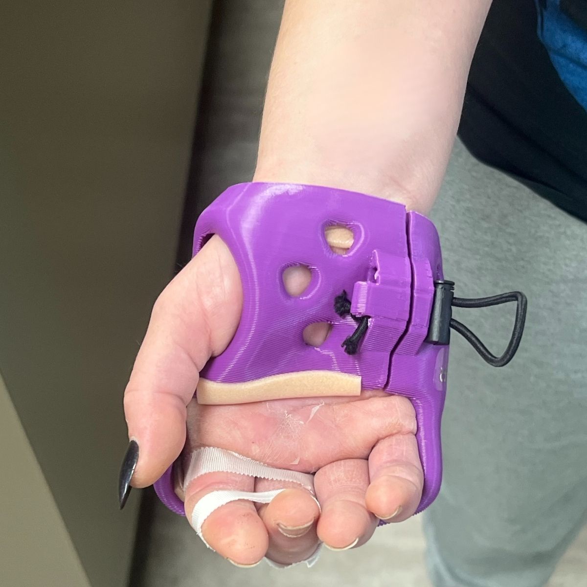 ActivArmor's tweet image. Dorsal MP blocker, short-hand gauntlet style for a bad industrial drill injury that nearly took her middle finger off &amp;amp; dislocated the MCP joints = back to work earlier for workers&apos; compensation case.  #ActivArmor #WaterproofCast #WorkersComp  #WorkplaceInjury