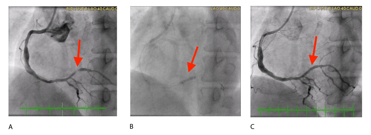 DeBakeyCVedu's tweet photo. #DCB effectively treat coronary in-stent restenosis, with outcomes superior to plain balloon angioplasty &amp; comparable to drug-eluting stents.

Drug-Coated Balloons for Coronary Interventions - @ahpatelmd @MarkAbdelnour1 @DrAFrangieh 

#DeBakeyCVJournal https://t.co/CNk6ZMfvQI https://t.co/9KmRNzBOMd