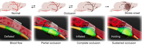 We’re thrilled to share our new preprint unveiling a remote-controlled microballoon platform that lets us titrate carotid flow on demand while imaging the brain’s real-time response in vivo:) It could be transformative for the study of brain hemodynamics!
biorxiv.org/content/10.110…