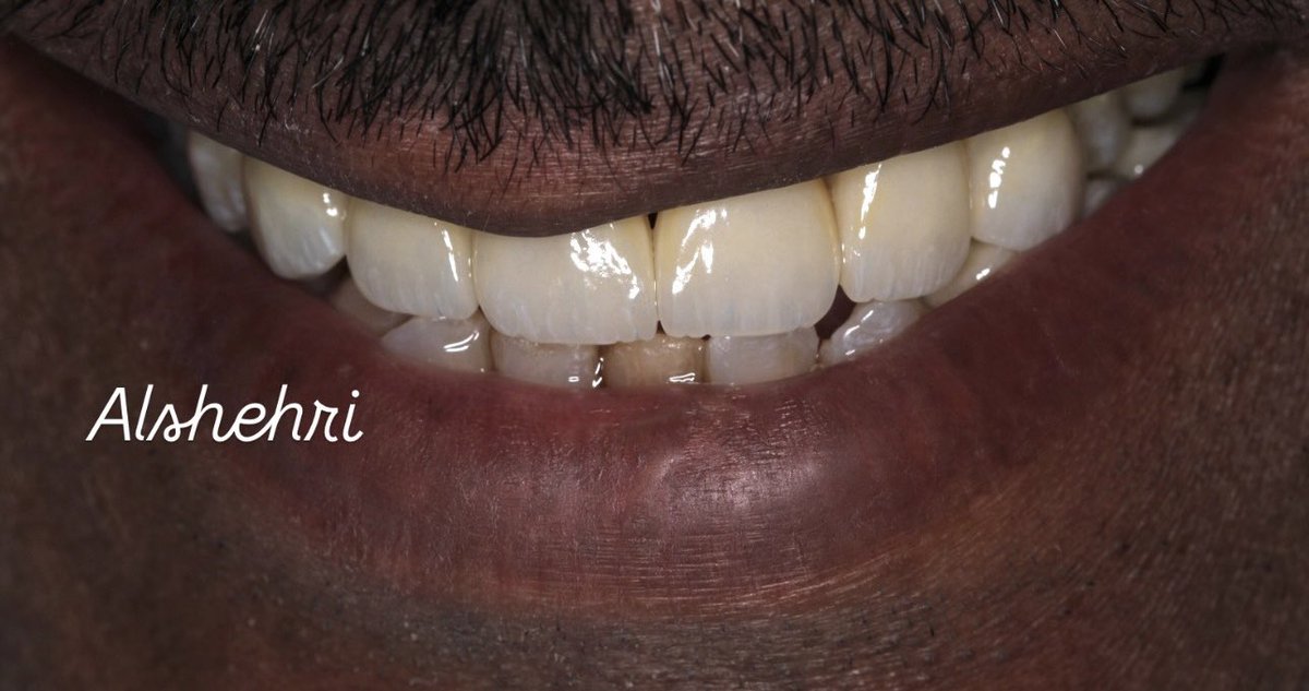 وحده من اجمل الحالات اللي اشتغلتها بالسنة الرابعه لي بالتخصص واستمتعت فيها بإشراف د. عبدالرحمن المالكي <a href="/abdulrahmanatq/">Dr. Abdulrahman Almalki د. عبدالرحمن المالكي</a> اللي له فضل كبير علي من بعد الله من الناحية العلمية والعملية