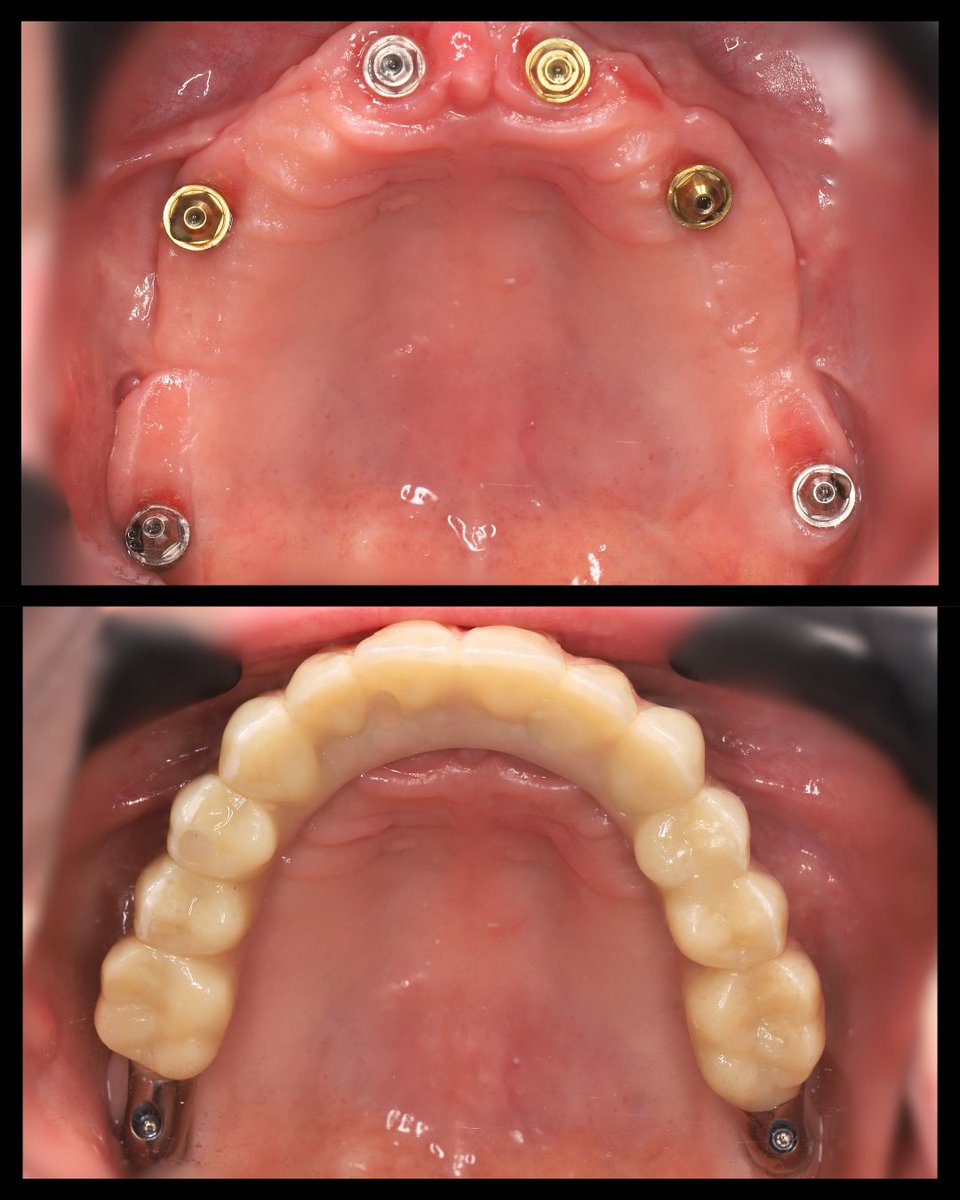 Dentalimplants8's tweet photo. Our patient presented with a primary complaint of discomfort with an upper partial denture and difficulty eating. Due to bone loss, the posterior upper teeth had failed, and the remaining teeth were showing advanced signs of tooth mobility. ⁠
⁠
We provided a full arch solution, a standard all-on-4, plus two pterygoid implants for maximum support and comfort. ⁠
⁠
Pterygoid implants are placed at the very posterior extremity of the upper jaw to provide a comprehensive full-jaw solution with twelve teeth for patients who have reduced bone in the upper anterior region. ⁠
⁠
Photos showing the differences between PMMA (acrylic) provisional bridges vs the final zirconia and titanium bridge. ⁠

#dentalimplants #missingteeth #dentistry