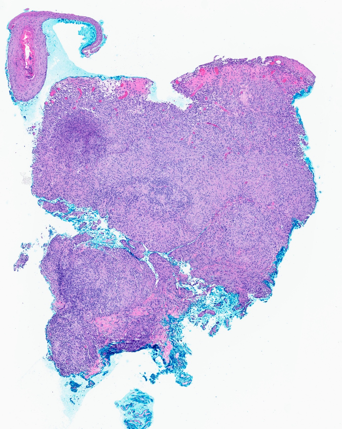 Cutaneous Leishmaniasis!!! Derm- the path to rule them all! The granulomatous pattern ...
Early: sheets of histiocytes/MF packed with amastigotes.
Later: granulomas with epithelioid histiocytes, multinuc. GC, lymphocytes, plasma cells.
#pathology #pathologists #pathTwitter