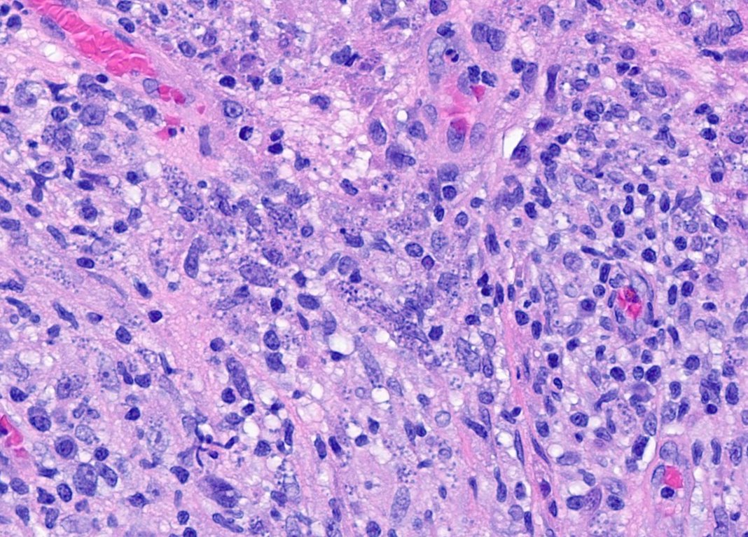 CakePath's tweet photo. Cutaneous Leishmaniasis!!! Derm- the path to rule them all! The granulomatous pattern ...
Early: sheets of histiocytes/MF packed with amastigotes.
Later: granulomas with epithelioid histiocytes, multinuc. GC, lymphocytes, plasma cells.
#pathology #pathologists #pathTwitter #dermatology #dermatologia #dermtwitter #infectiousdiseases