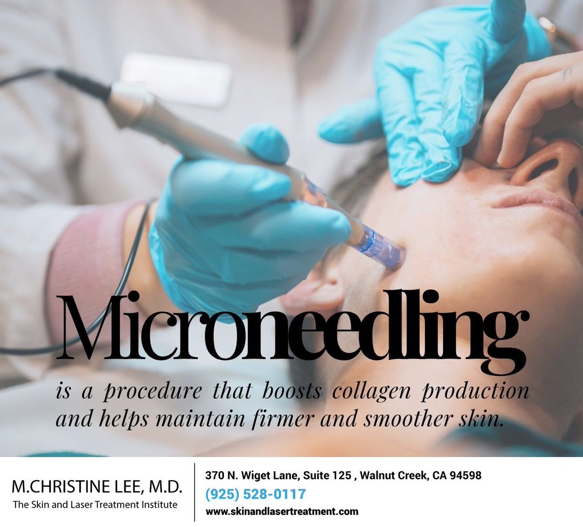 TheSkinandLaser's tweet photo. Enhance the look and texture of your skin and reduce the appearance of common skin problems with microneedling. Experience the cosmetic and medical benefits; call (925) 528-0117 to book your visit. #microneedling #walnutcreek #CA #skinandlasertreatment https://t.co/4N6JiECa0i