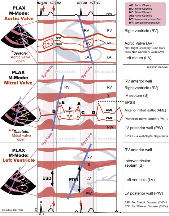 M-Mode Echocardiography Explained

This figure demonstrates M-mode measurements from the parasternal long-axis (PLAX) view, crucial for assessing valvular &amp; ventricular function:

🔹 Aortic Valve Motion (Top Panel)
- The right coronary cusp (RCC) and non-coronary cusp (NCC) move