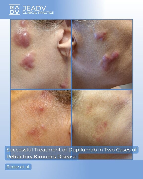 Blaise et al. report two refractory #Kimuradisease cases—marked by #nodules, lymphadenopathy, eosinophilia &amp; high IgE—successfully treated with #dupilumab, showing promise as a safe, effective Th2-targeted #therapy.

Full article 👉 bit.ly/4mfvjF7