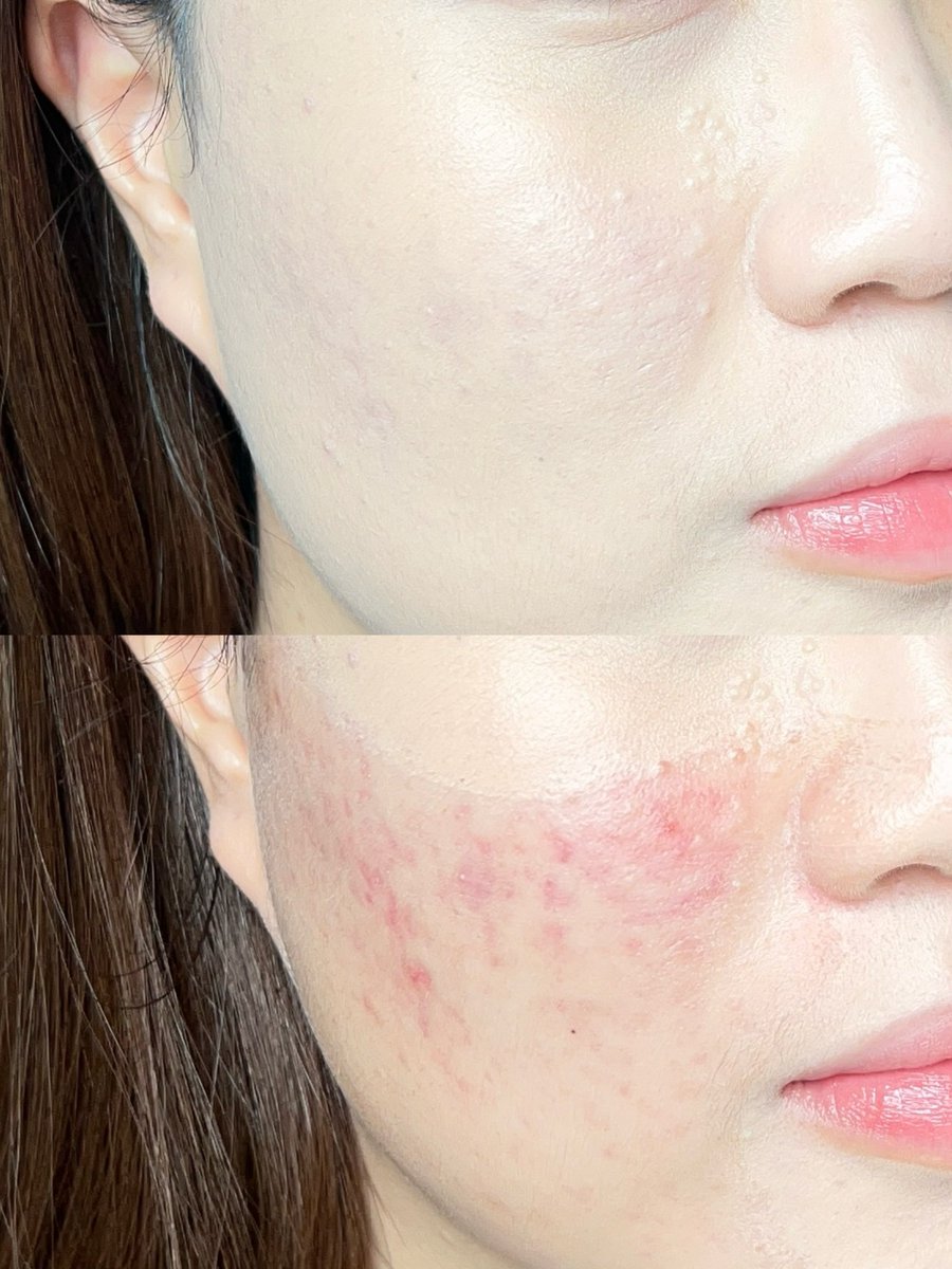 ในฐานะของคนที่มีรอยสิวเหมือนกัน ขอแนะนำ Glad2Glow เลยค่ะ ปกปิดดี งานฉาบผิวใหม่ ไม่หนักหน้า มีหลายเบอร์ ราคาไม่เกิน 300 บาท แนะนำให้เซ็ตแป้งเพิ่มนิดนึงคือติดทนทั้งวันแน่นอน