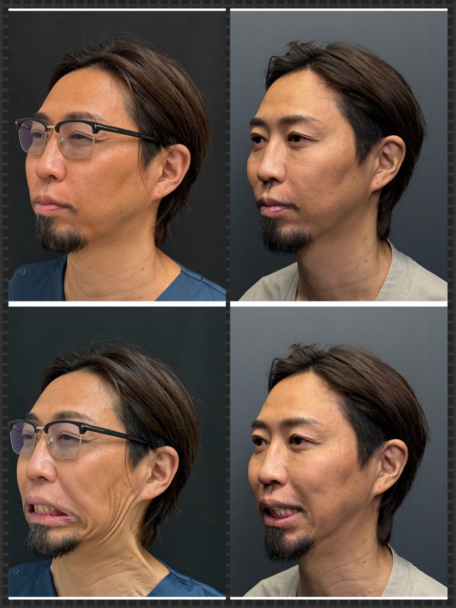 asc_yokoyama's tweet photo. 広頚筋ボトックス（ボトックスリフト）
しっかり効いてるの図。
頬が上がったかといえばわかりにくいが、フェイスラインはスッキリしたよ。
（自覚的には割とある）

担当はもちろんミカ先生@Dr_miiiika https://t.co/d7phIP0g1V