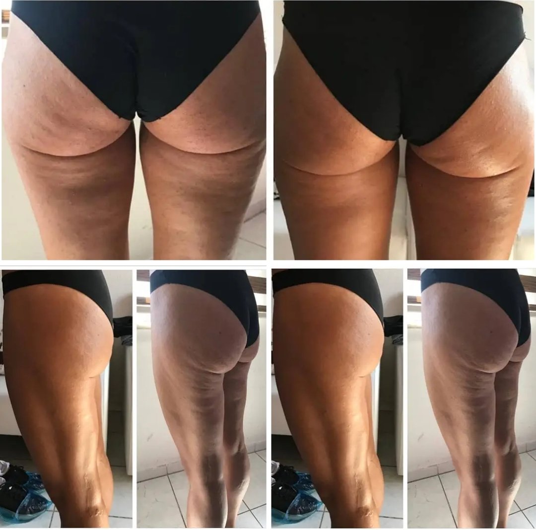 Selülit Masajı 

Özel otantik natural yağlar ile selülit masajı 

Öncesi Sonrası 

#adana #seyhan #çukurova #mersin #massage #thai #selulit