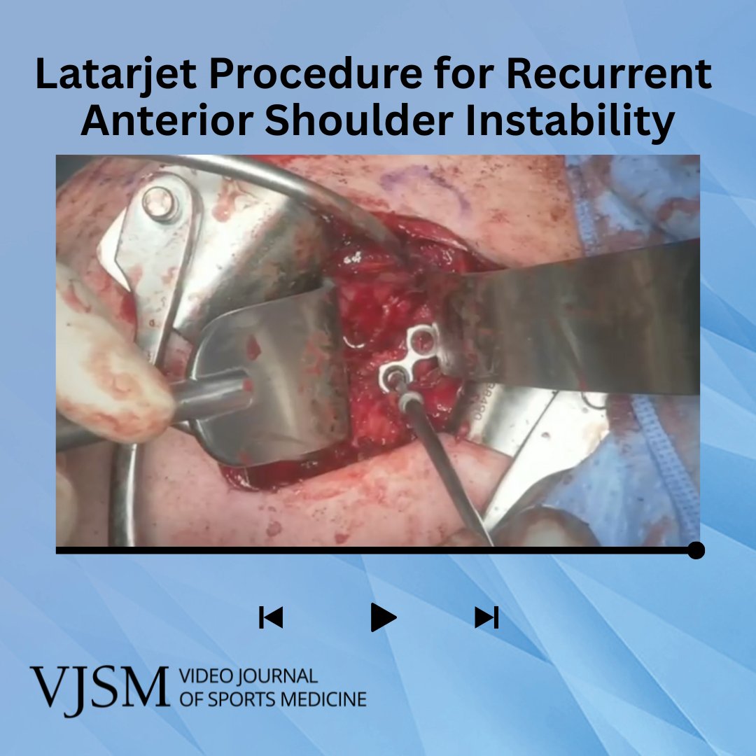 aossmjournals's tweet image. The Laterjet procedure is reproducible and portends excellent outcomes for patients with recurrent anterior shoulder instability. 

ow.ly/c5sI50WTeHC 

 #ShoulderSurgery #OrthopedicSurgery