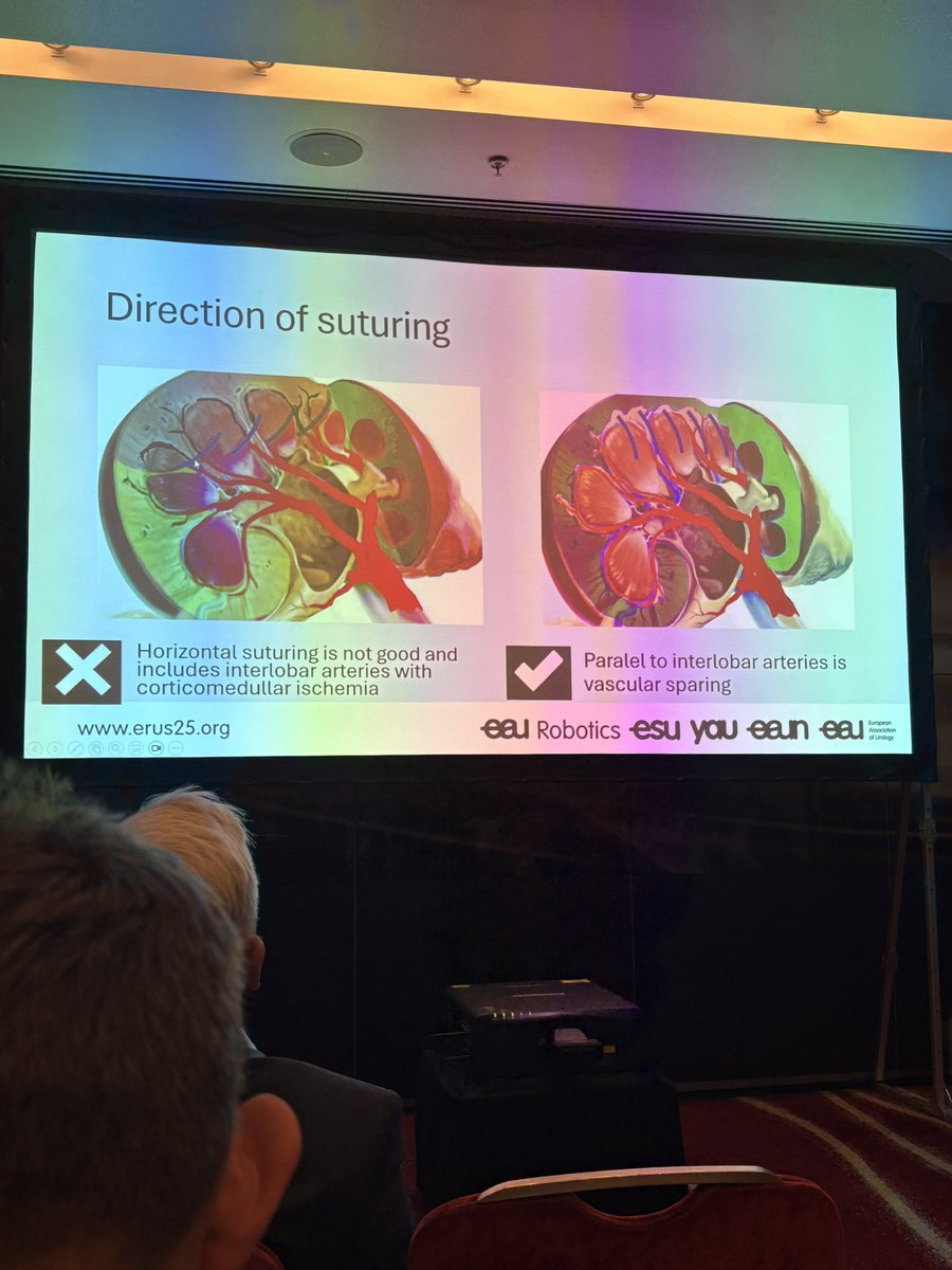 sachrana11's tweet photo. Great RAPN masterclass session at #ERUS25 good revision of anatomy, renorrhapy technique and complication mx.. finished off by live sutureless off-clamp RAPN by  @alexmottrie  @Uroweb https://t.co/ekU5DR6mtD